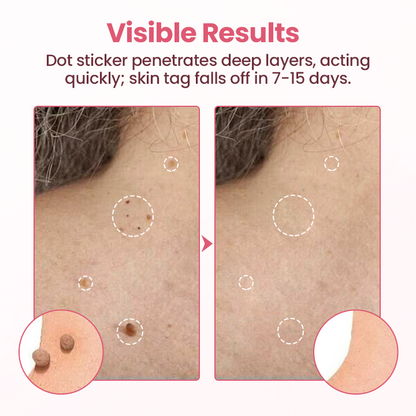 Biancat® Painless Micro Wart Removal Patch